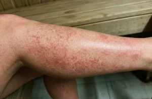 Fleky na kůži po sauně: Neškodné zdravé prokrvení nebo nebezpečná reakce?