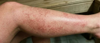 Fleky na kůži po sauně: Neškodné zdravé prokrvení nebo nebezpečná reakce? Fleky na kůži po sauně: Neškodné zdravé prokrvení nebo nebezpečná reakce?