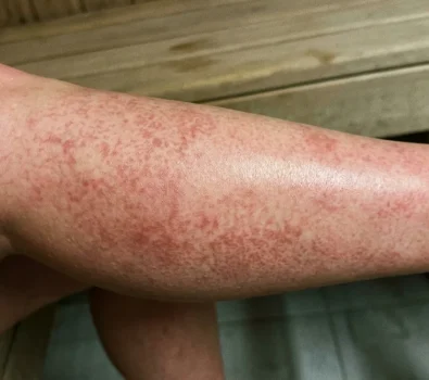 Fleky na kůži po sauně: Neškodné zdravé prokrvení nebo nebezpečná reakce?