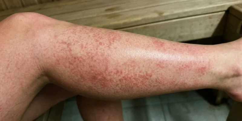 Fleky na kůži po sauně: Neškodné zdravé prokrvení nebo nebezpečná reakce? Fleky na kůži po sauně: Neškodné zdravé prokrvení nebo nebezpečná reakce?